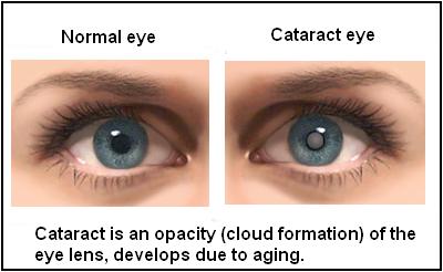 Cataract & Glaucoma Hospital